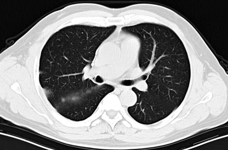 海南首例恶性胸膜间皮瘤,胸膜间皮瘤生存5年算治愈吗