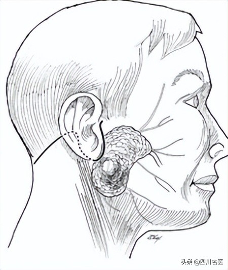 摸到颌面部肿瘤,摸到颌下有小疙瘩