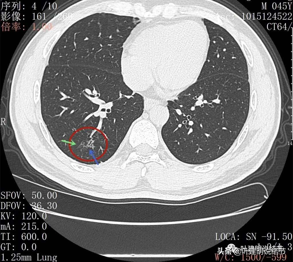 误诊肺纤维化,肺蜂窝状是癌吗