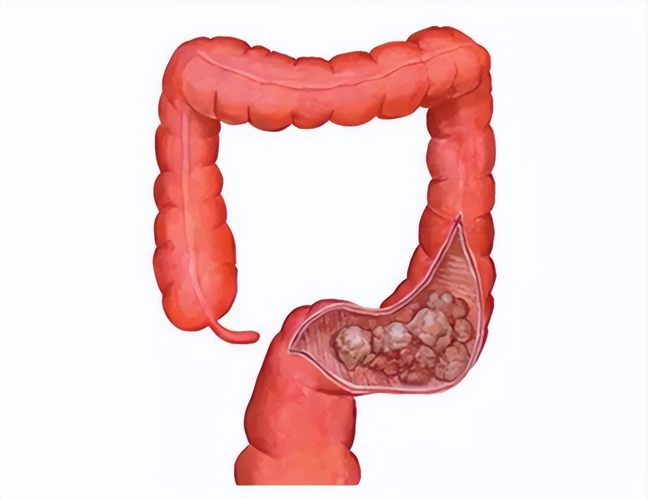 一直感觉大便拉不干净是怎么回事,大便感觉老是拉不干净是什么原因