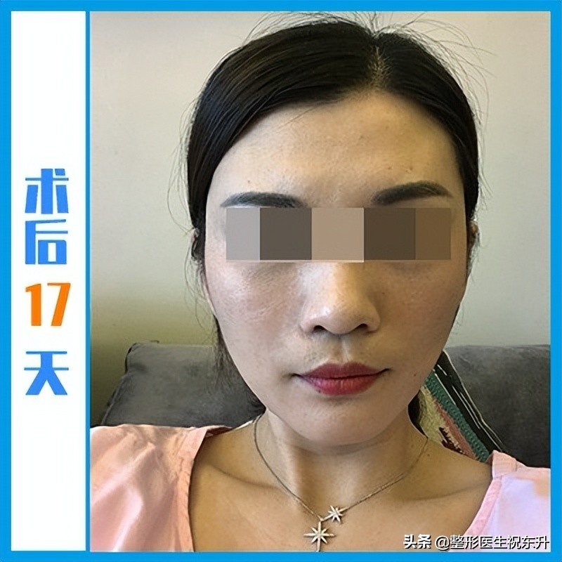 面诊后拉皮除皱,小切口拉皮手术后第一天记录一下