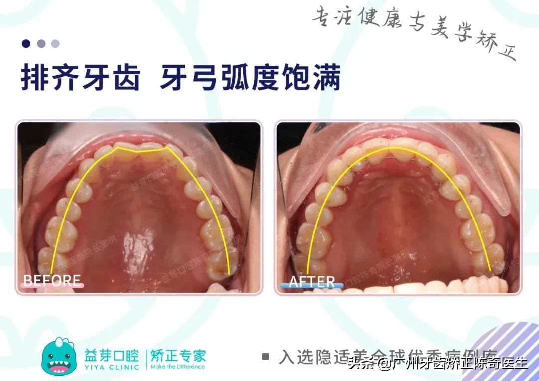 隐适美矫正和普通矫正的区别,隐适美矫正有几种版本