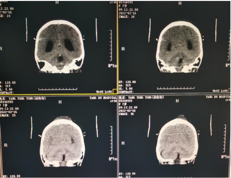 第四脑室室管膜瘤手术怎么做,第三脑室管膜瘤治疗方法