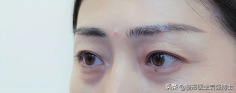 眼周年轻化手术效果可以持续多久,眼周医美项目