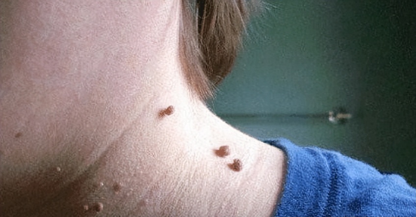 感染hpv导致宫颈癌还能治好吗,感染hpv导致癌变的几率