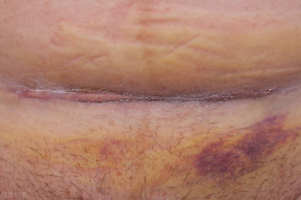 剖腹产疤痕宝妈们用什么修复,剖宫产疤痕憩室怎么去除