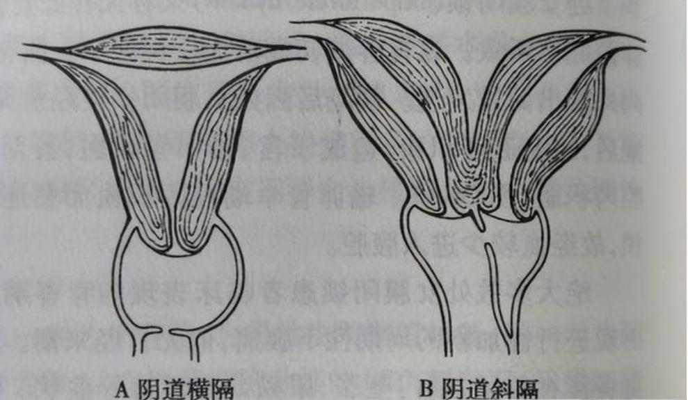 女子检查出两个子宫,女子查出双子宫