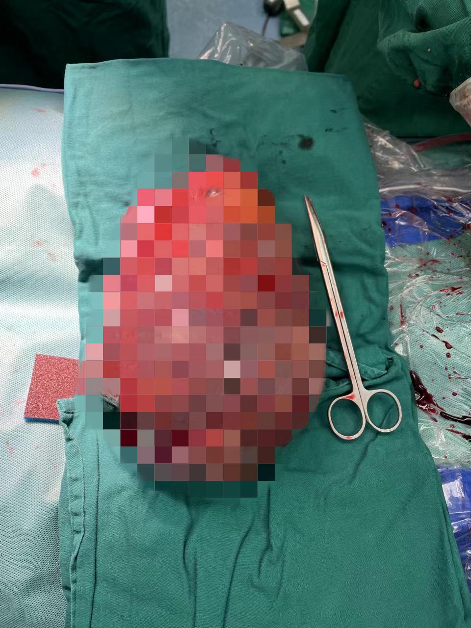 7斤2两！女子高挺肚子像孕妇，医生取出巨大肿瘤