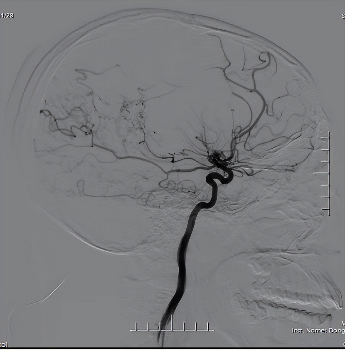 14宀佺敺瀛╃獊鐒剁儫闆剧梾,13宀佺敺瀛╃儫闆剧梾鎬庝箞寰楃殑