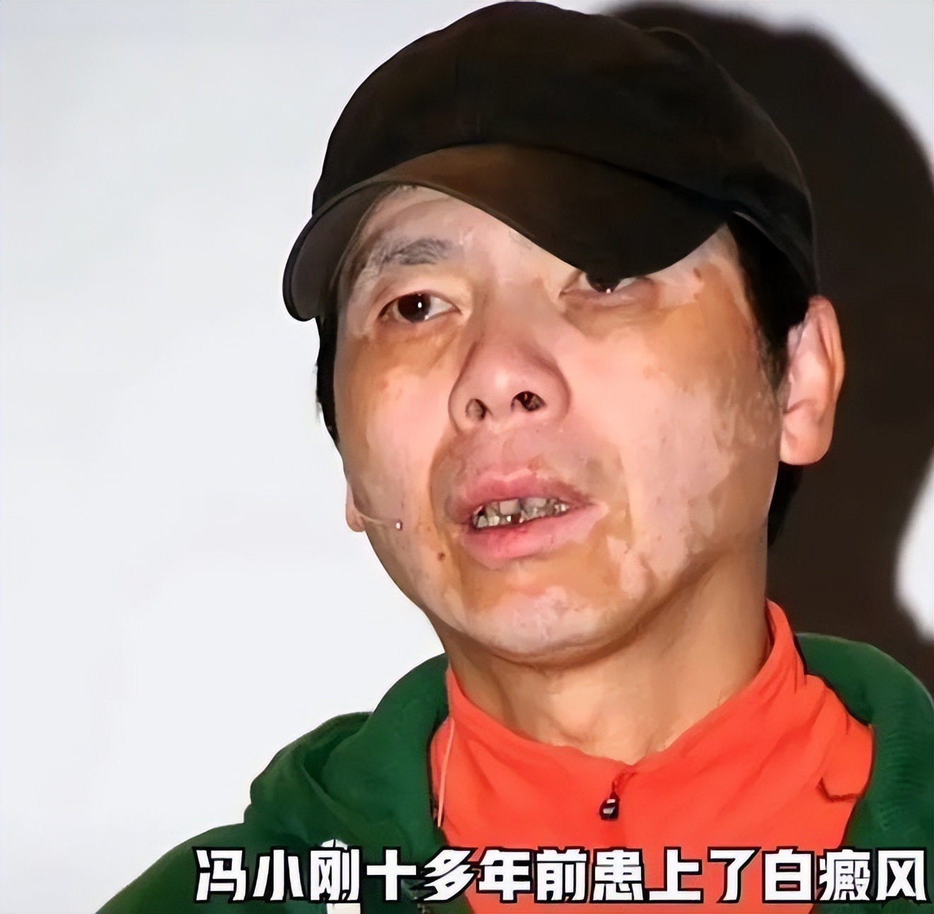 冯小刚白癜风多长时间治愈的,冯小刚的白癜风为什么治不好