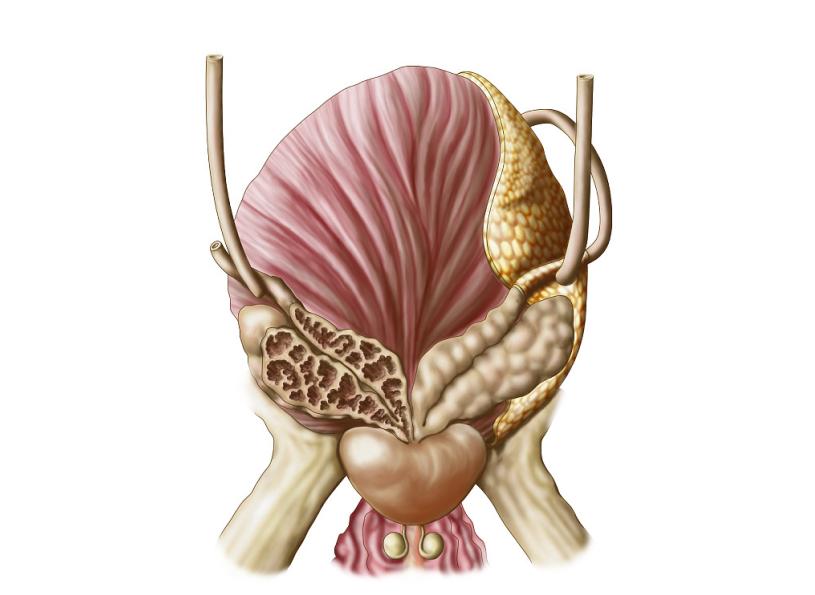 前列腺钙化有什么危害该怎样治疗,前列腺钙化有什么影响及后果