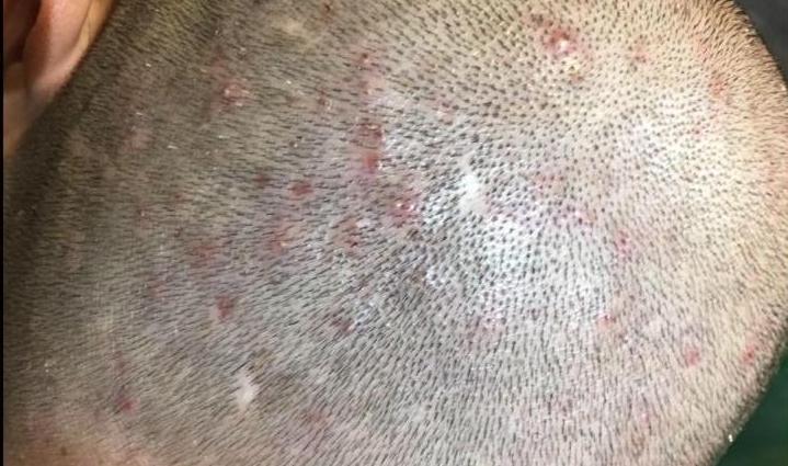 头皮总是长疙瘩是怎么回事,头皮上老长疙瘩怎么回事