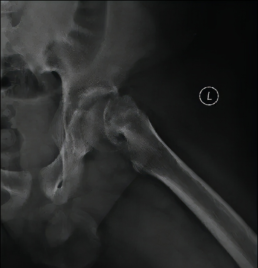 小儿骨科科普类短视频,股骨头骨骺滑脱中医手法治疗