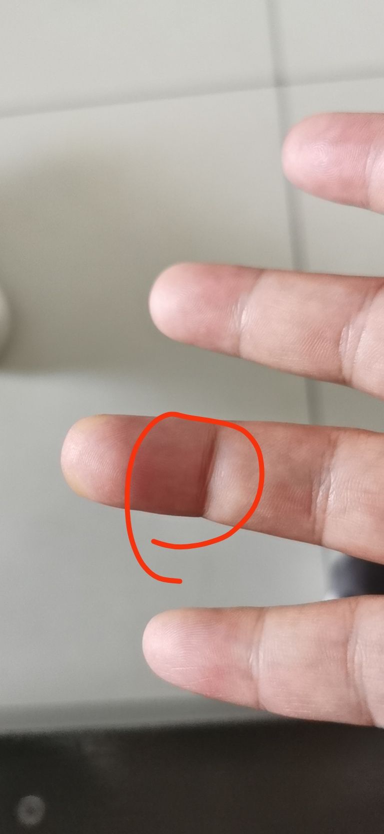 手指韧带断裂重建手术,手指韧带断裂恢复训练多大强度