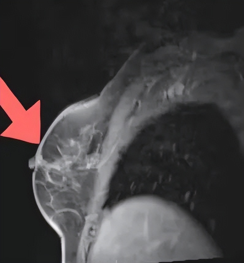 汉曲优曲妥珠单抗治疗效果,her2阳性乳腺癌新辅助治疗的启示