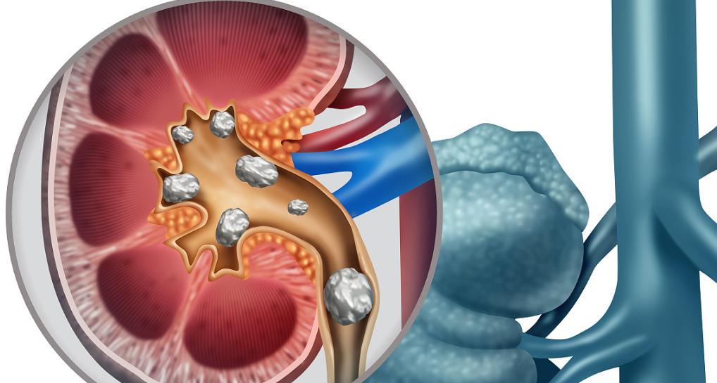 肾结石是什么病，治疗不及时会发生什么？术后护理需要注意些什么