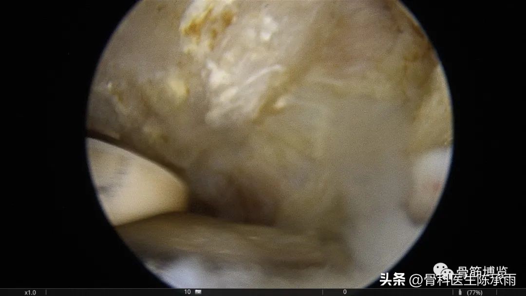 肱二头肌长头肌腱断裂超声报告,上臂肱二头肌