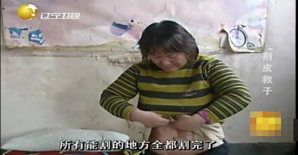 切肤之爱真实上演，河北妈妈割皮救子，就算割光全身的皮也不怕