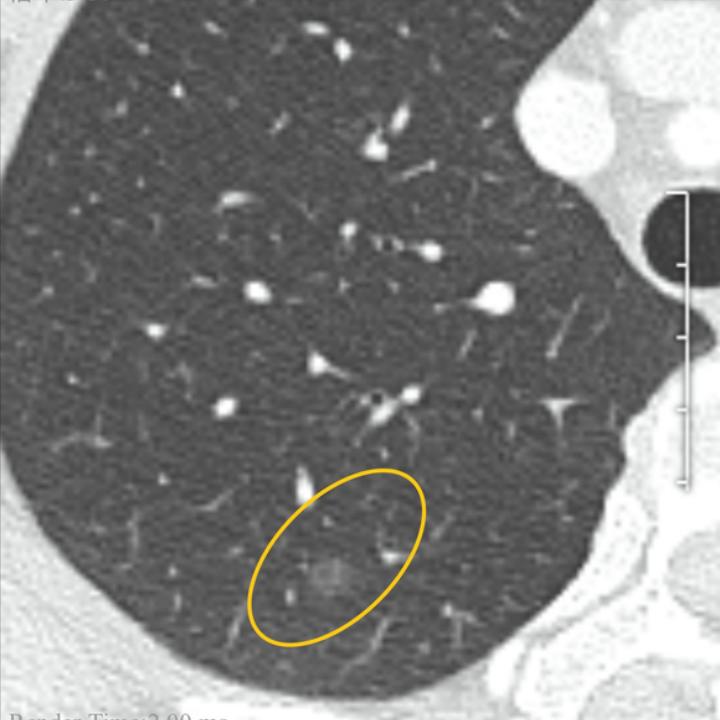 宫颈癌术后肺磨玻璃结节,宫颈癌或者癌前病变