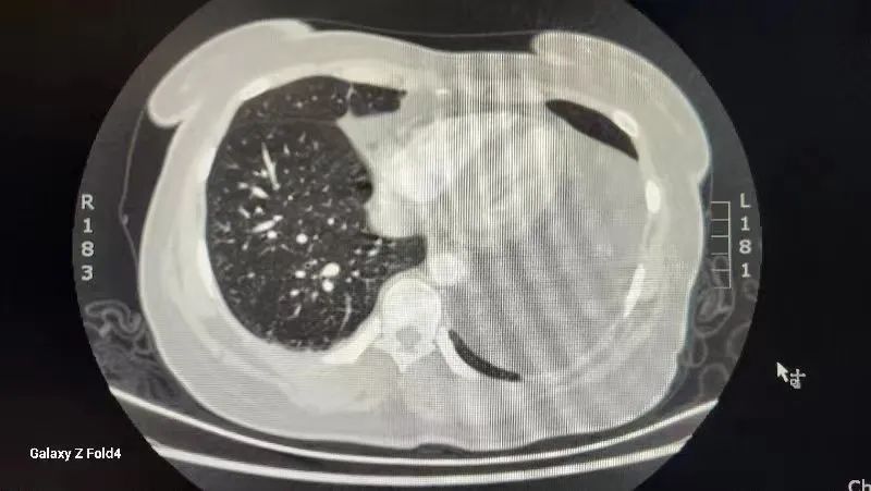 市中心医院胸外科：镜下“小切口”解决纵膈“大问题”