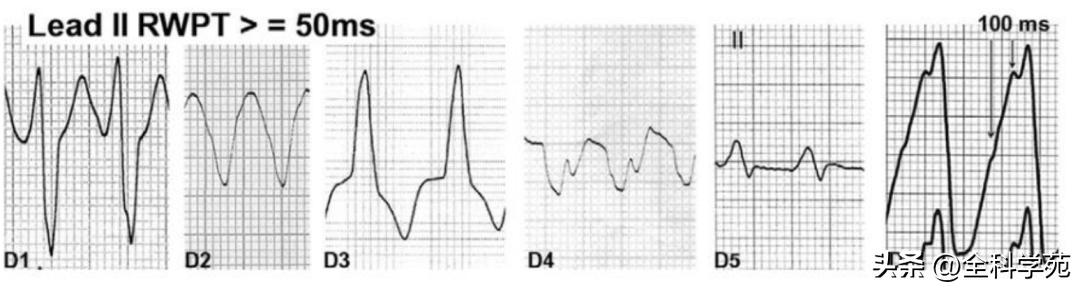 心电图上表现为宽qrs波,心电图中qrs是代表心动过速吗