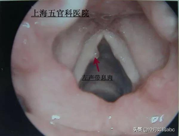 话说息肉：天生我才必有用，身体拒绝“休息之肉”