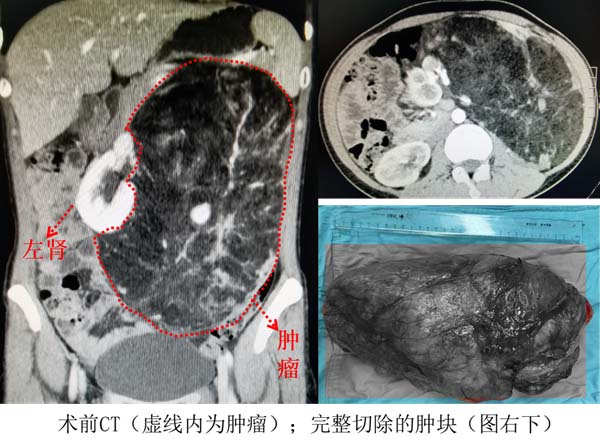 体检发现肾脏上有了占位怎么办,体检发现左肾肿瘤两周是什么意思