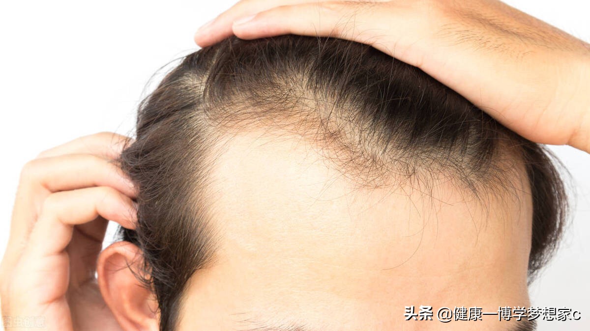 用了六个月米诺没效果,用米诺地尔酊6个月还掉发