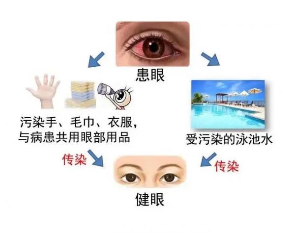 红眼病最新,医院最近眼科红眼病多了咋回事