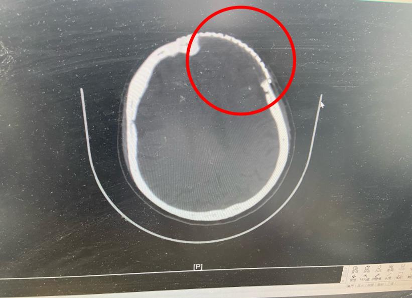 女子额头长包一查竟是肿瘤,额头长个包说是肿瘤