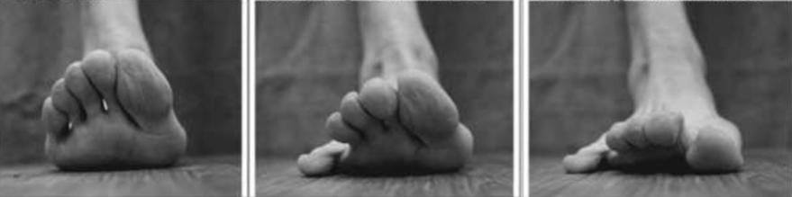 专家支招爱美女士，别让“水晶鞋”内的双脚受伤了