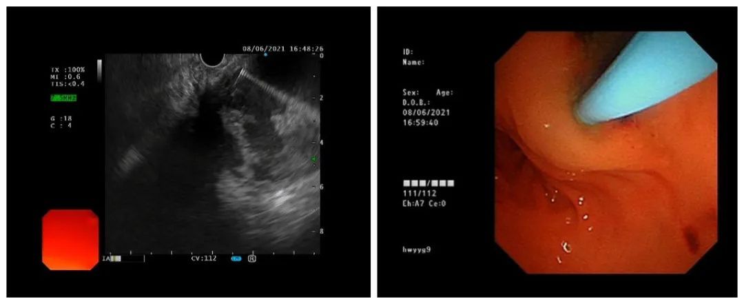 5岁小孩腹部囊肿怎么治疗,小儿腹部囊肿生长很快