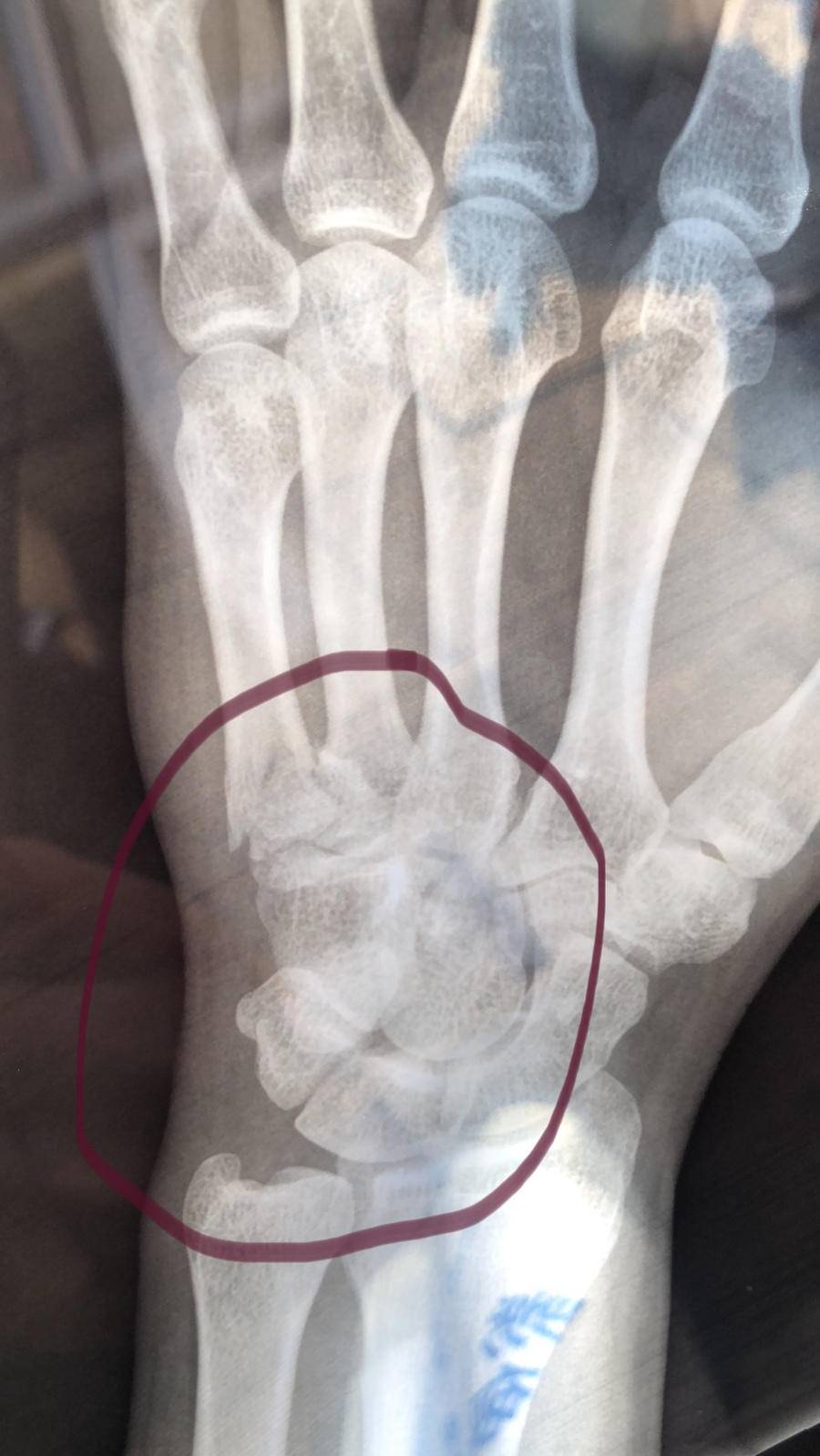 掌骨断了,嫌疑人也没脱出他的手