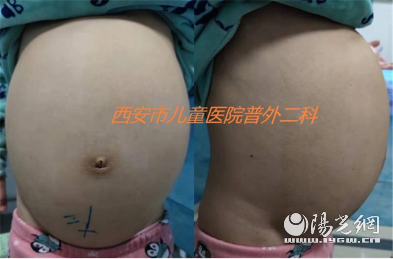 宝宝青蛙肚怎么回事,宝宝青蛙肚需要去检查吗