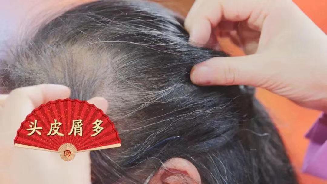 天天洗头容易脱发,天天洗头越来越油什么原因