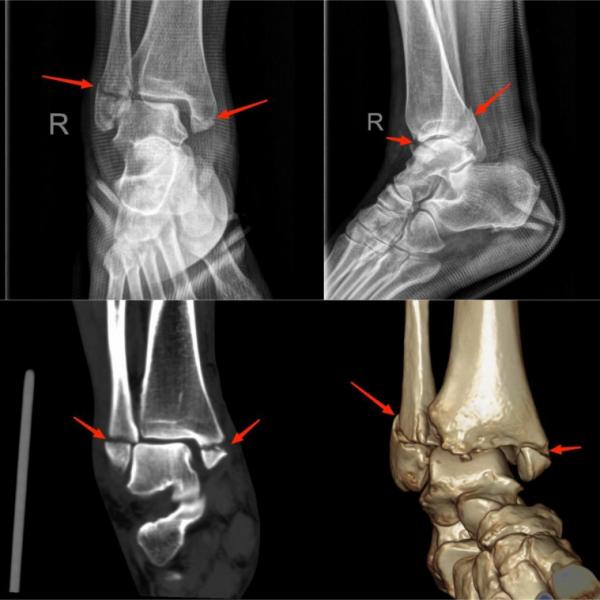 足球运动膝盖损伤,运动损伤科普