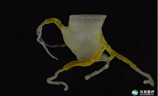 3DF打印助力温州医科大温州医科大学附属第一医院周浩团队完成一例复杂高危的冠脉CTO手术