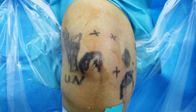 烟台山医院微创手术流程,烟台山医院做膝盖关节手术