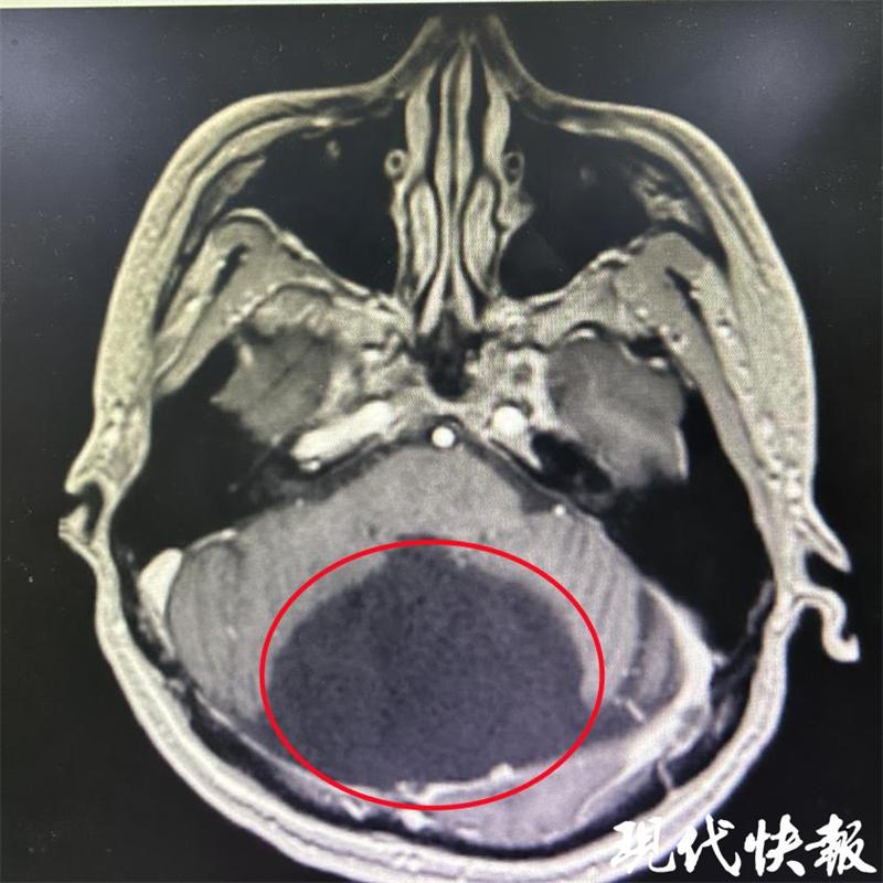 头疼警惕脑梗,右侧小脑蛛网膜囊肿能引起头疼吗