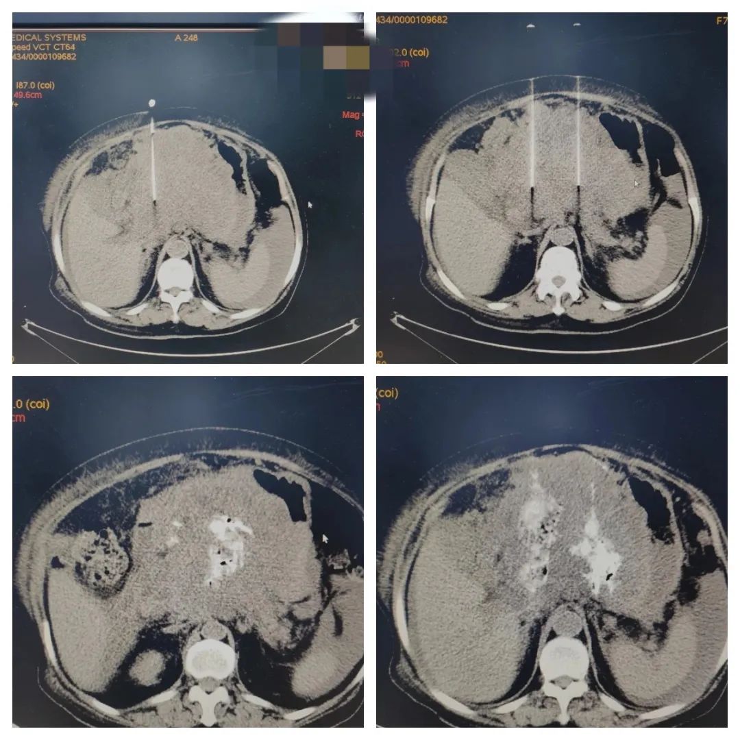 无水酒精消融术医生准备工作,无水酒精消融术用的什么酒精