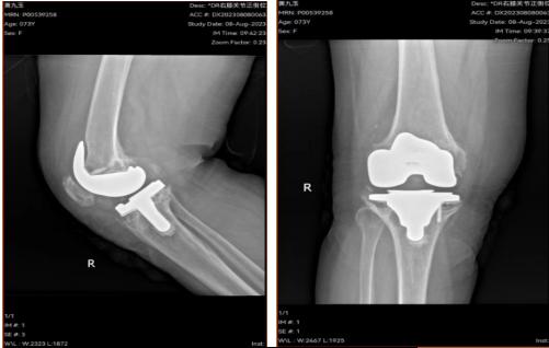 膝关节翻修手术最好医院,膝关节软骨重建手术