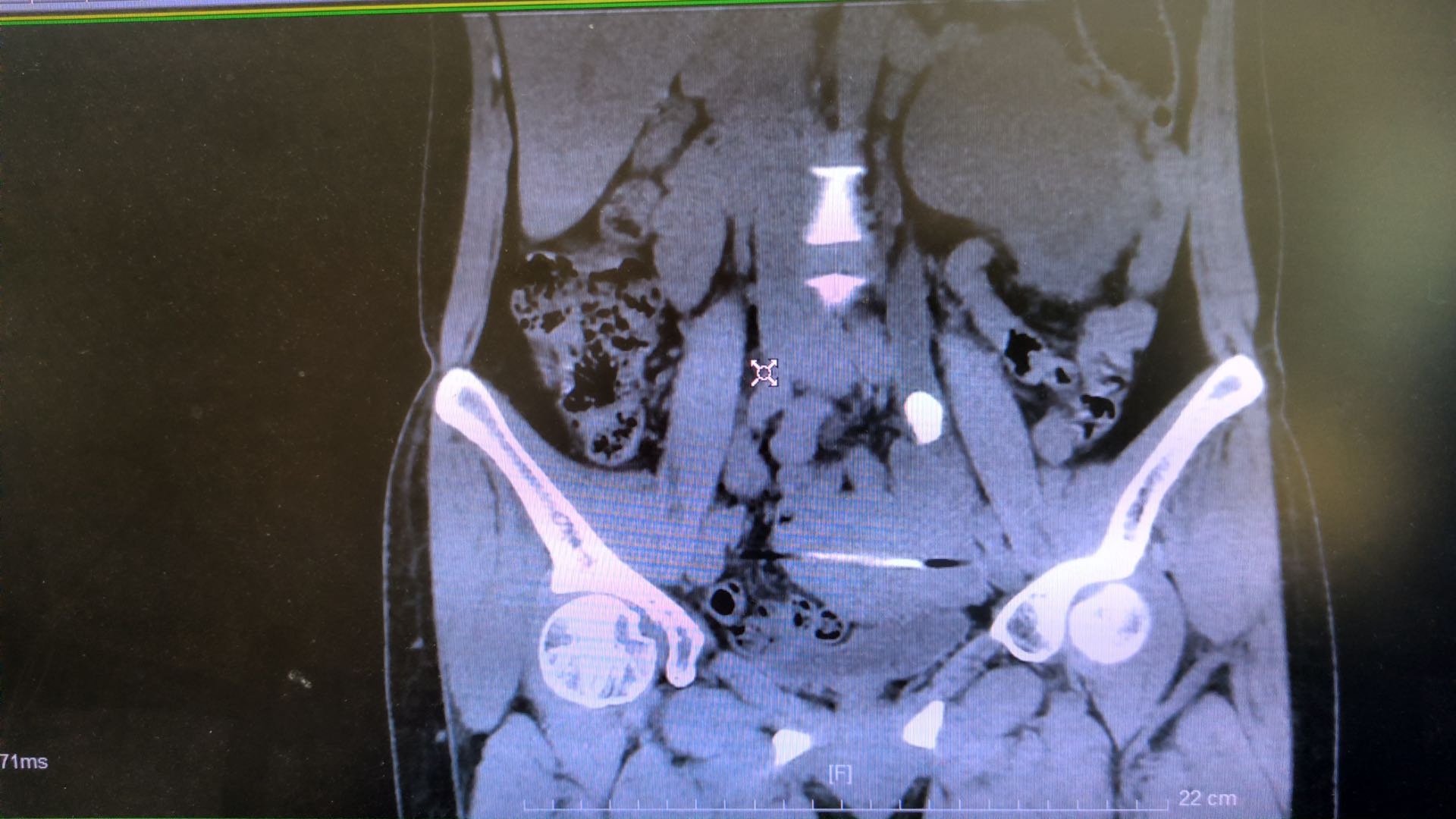 碎石清石治疗输尿管结石,碎石后快速排结石